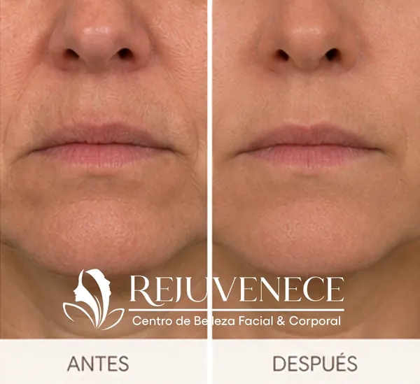 Resultados Botox San Miguel