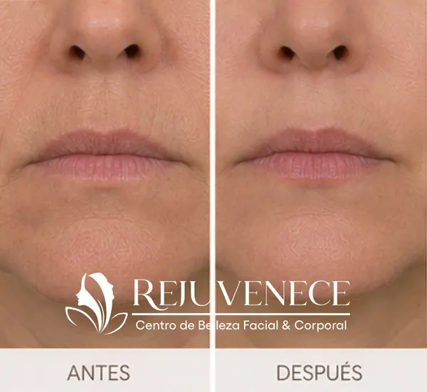 Botox expresion natural